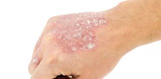 psoriasis