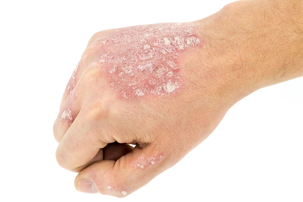 psoriasis