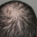 perte-de-cheveux