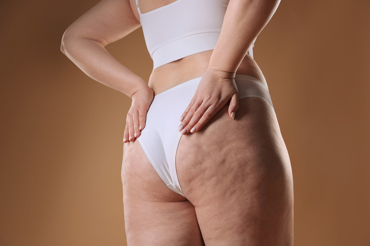 astuces pour enlever la cellulite