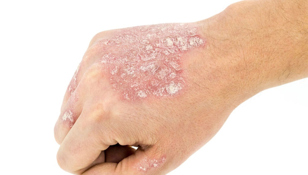 Psoriasis