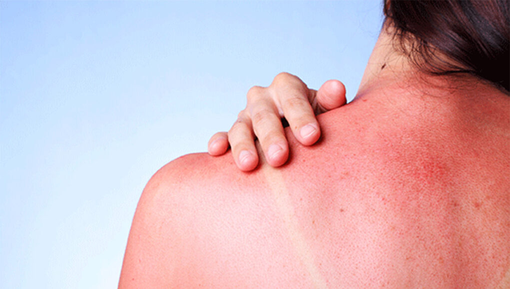 remèdes et astuces contre les coups de soleil
