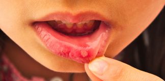 remèdes naturels contre les aphtes