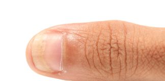 soigner naturellement les mycoses aux ongles