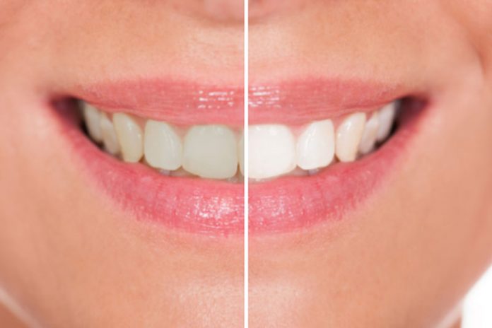 se-blanchir-les-dents Se blanchir les dents