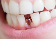 implant dentaire